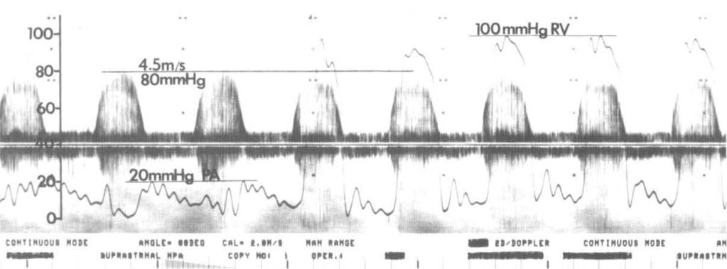 740 DOPPLER IN CONGENITAL HEART DISEASE Mayo Clin Proc, September 1986, Vol 61 MK MMU«MM«CM. I.Ms«MITt MUM Fig. 20. Pulmonary stenosis.