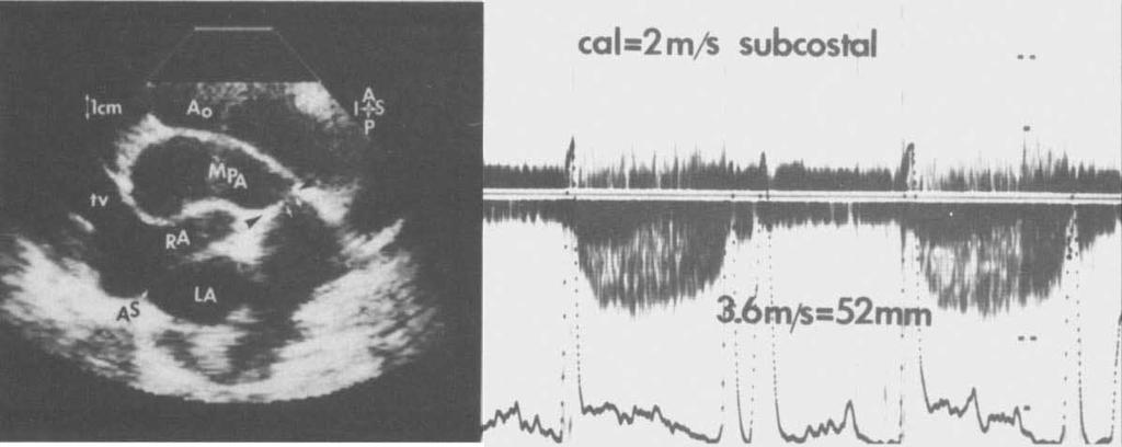 A band constricts the main pulmonary artery (arrow and arrowheads). Right, Continuous-wave Doppler examination from subcostal position.