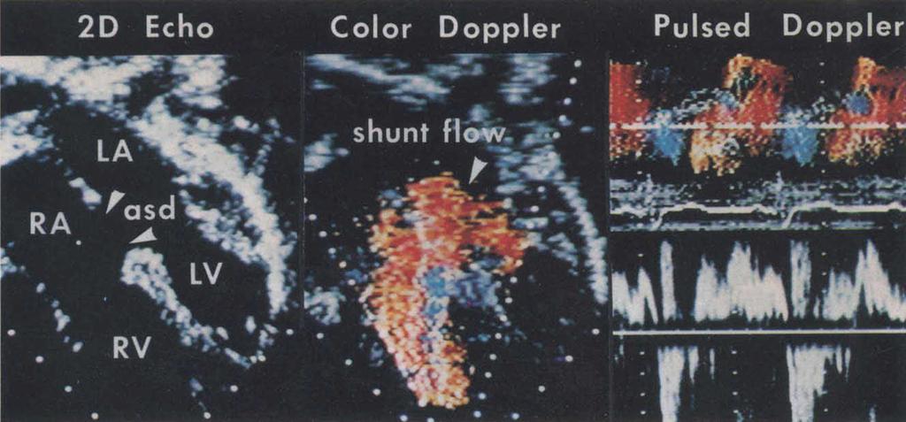 728 DOPPLER IN CONGENITAL HEART DISEASE Mayo Clin Proc, September 1986, Vol 61 Fig. 2. Secundum atrial septal defect, as depicted on color flow Doppler imaging.