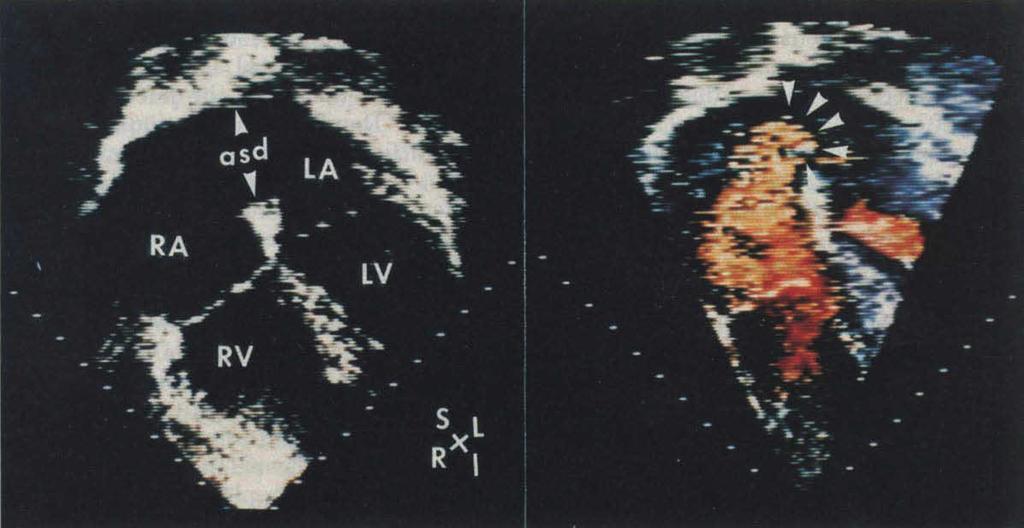 Right, Left-to-right shunt flow, manifested as abnormal (orange) flow velocities that begin at site of defect (arrowheads) and fill most of right atrium.