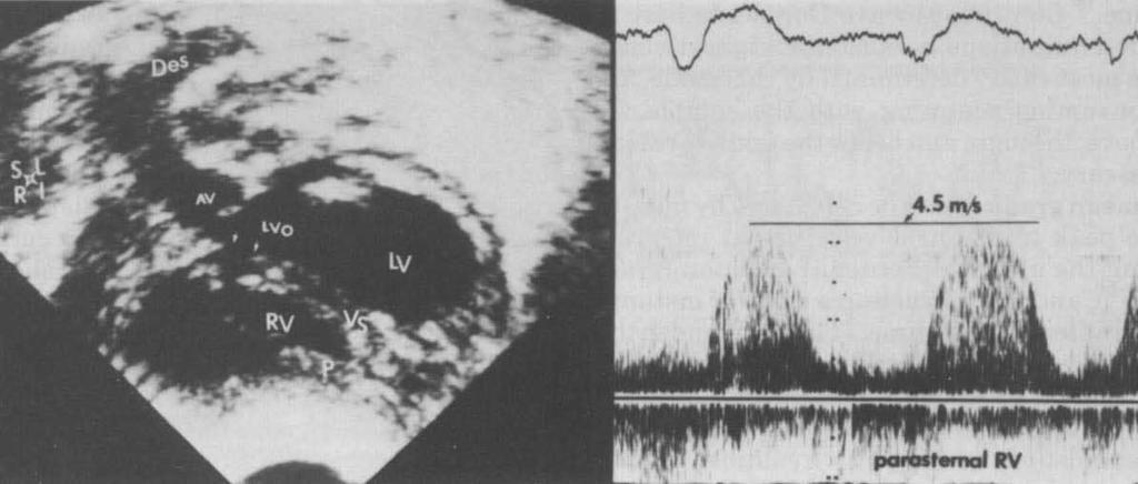 5 m/s corresponds to a peak instantaneous pressure difference of 81 mm Hg between left and right ventricles.