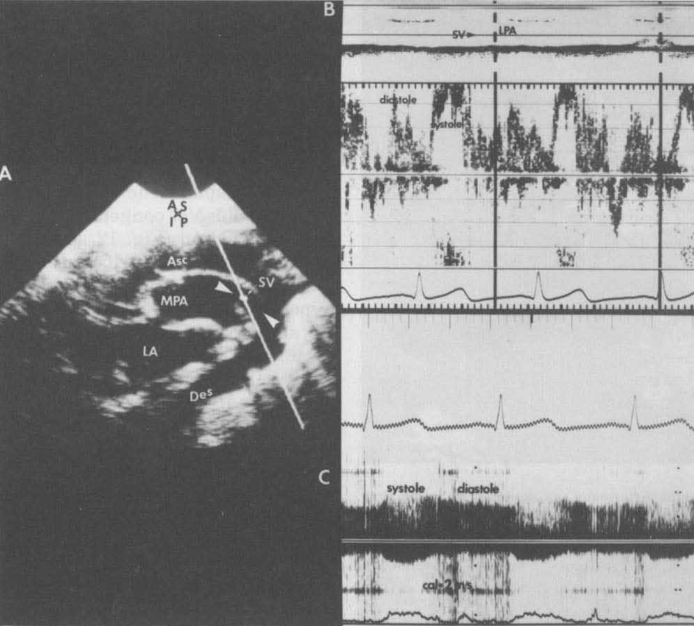 Mayo Clin Proc, September 1986, Vol 61 DOPPLER IN CONGENITAL HEART DISEASE 731 Fig. 7. Patent ductus arteriosus. A, High parasternal long-axis image of aorta and pulmonary artery.