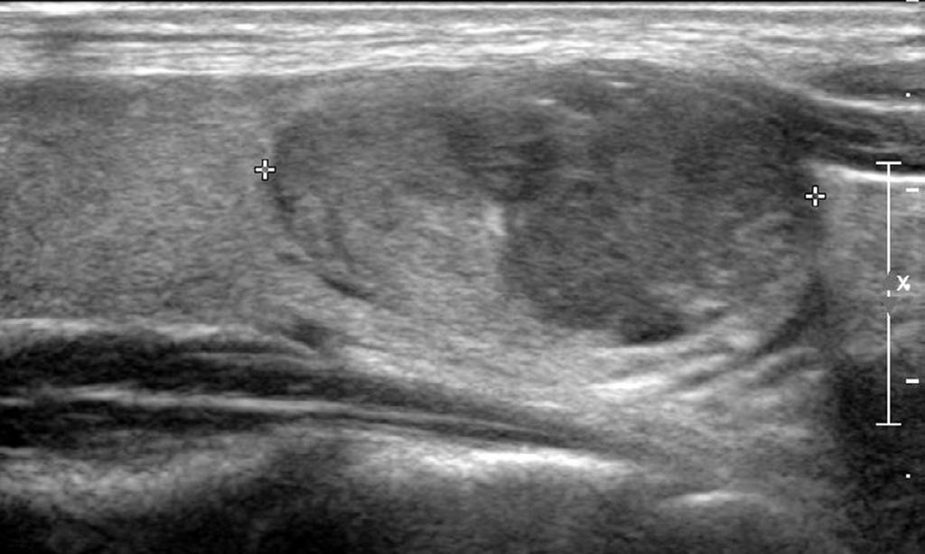 lobe (arrows, 16.0 mm 24.8 mm 28.5 mm). C. A longitudinal color Doppler ultrasonography shows marked intranodular vascularity (arrows).