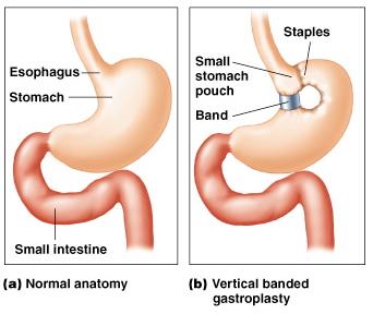 Surgical Options Stomach Surgeries When obesity is severe (BMI >35) Health risks from obesity are extreme