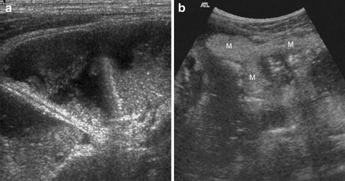458 Fig. 2 a US image showing a dilated small bowel loop in a patient with secondary signs, but without the depiction of the appendix itself.