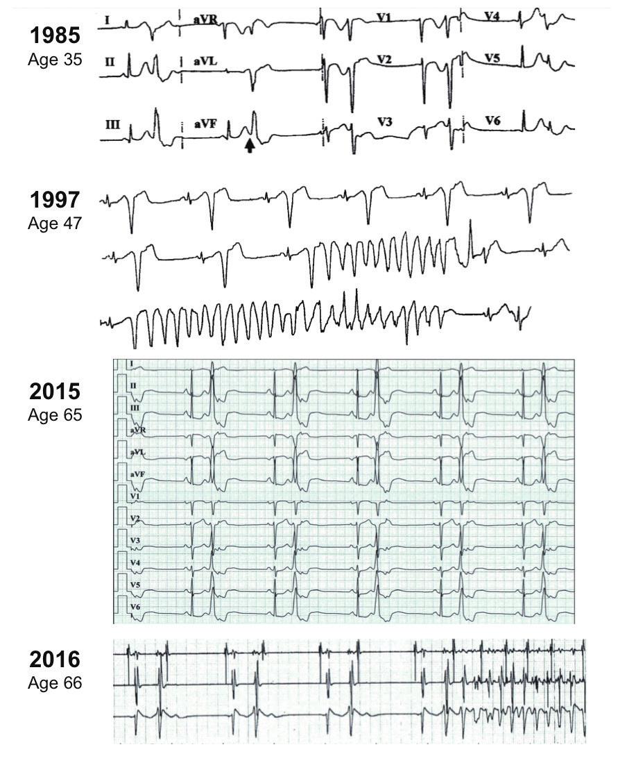 300 Idiopathic Polymorphic RVOT-VT C D Fig. 1. female patient with a very long history of palpitations.