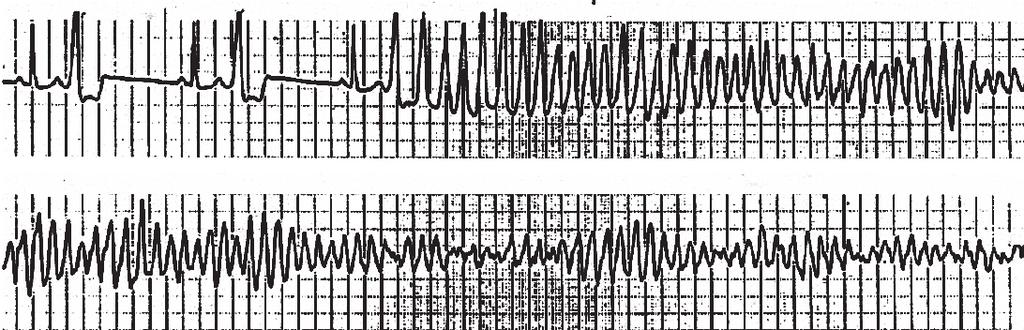 Sami Viskin 301 of typical (Purkinje-related) idiopathic VF 9) (355±30 vs. 280±26 msec, p=0.01). 14) In addition, RVOT extrasystoles are wider than the Purkinje-related ectopic beats (145±12 vs.