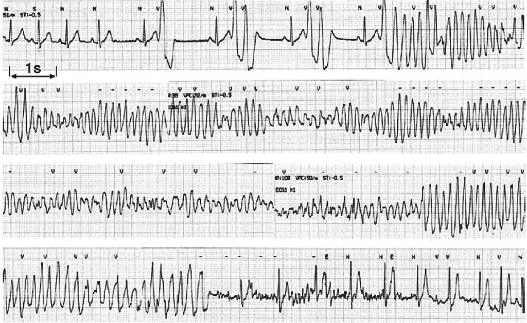4) and who have little-to-no ventricular ectopic activity between arrhythmic events, patients with idiopathic RVOT VT have a long history of palpitations and have frequent RVOT extrasystoles (often