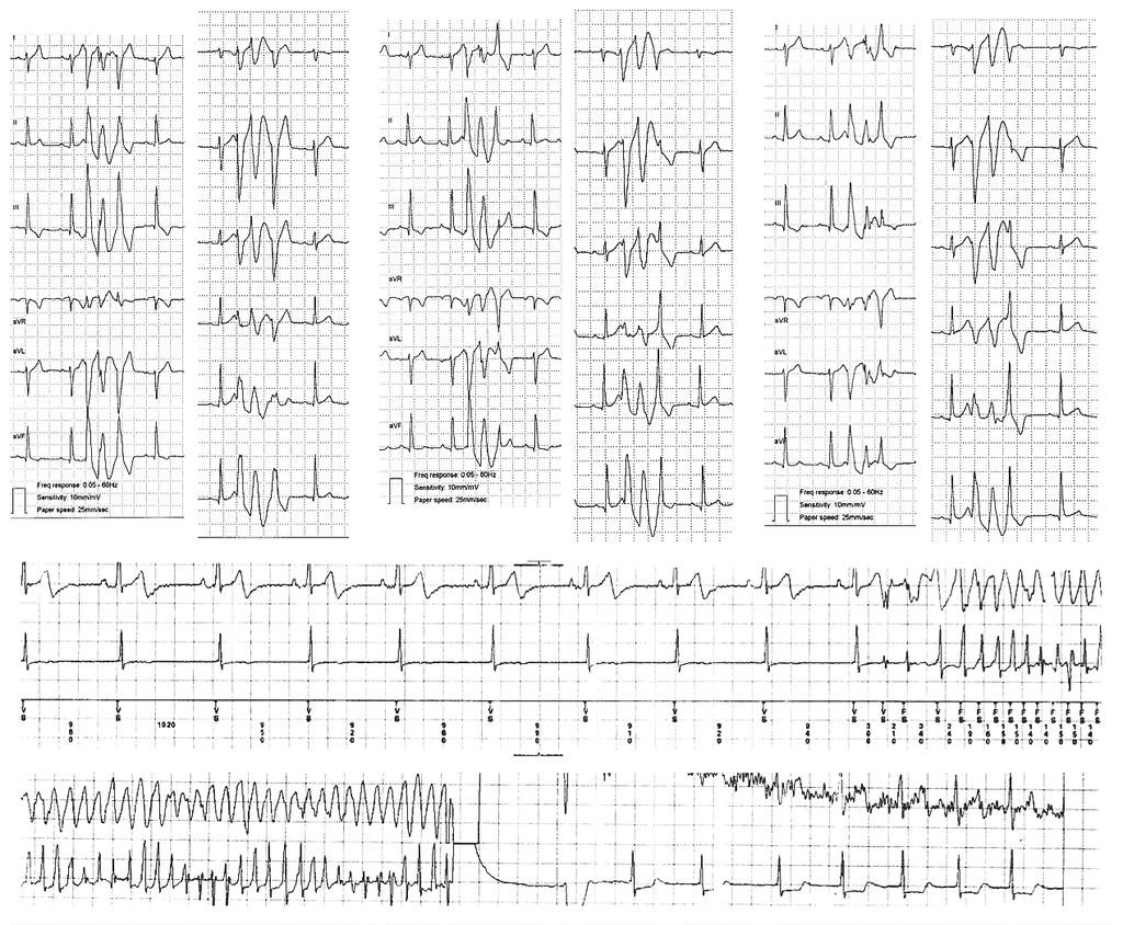 302 Idiopathic Polymorphic RVOT-VT C D Fig. 4. 20-year-old male with idiopathic VF. Cardiac arrest was the presenting symptom. Ventricular extrasystoles were fortuitously recorded only once.