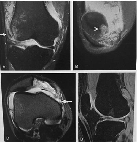 presentation, gentle knee extension with medial force to achieve reduction Aspiration of hemarthrosis may be considered Assess for patella alta, tenderness