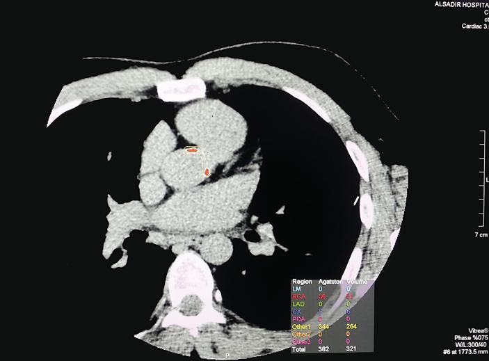 168 Color version available online Fig. 1. Aortic root calcium score measurement by MDCT.