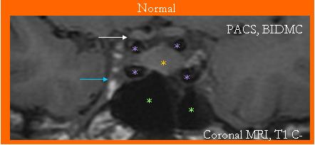 Sellar Anatomy (Coronal) 1. Optic Chiasm 2. Pituitary Gland 3.