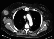 CLINICAL CASE OF THE MONTH A 57-Year-Old Man with an Axillary Mass Palak Desai MD, Andrew Myers, Brian Boulmay MD, Fred A.