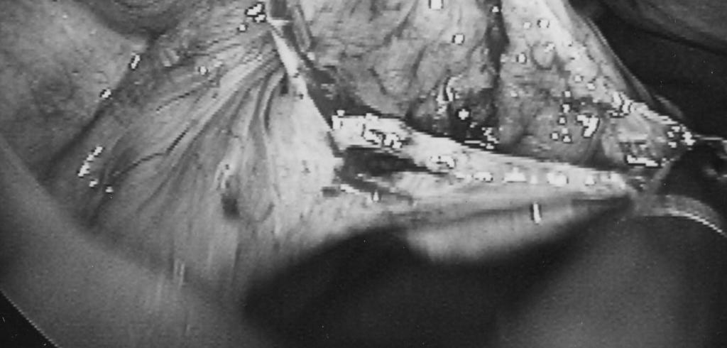 surgical procedure Tubal endoscopy Falloposcopy (Kerin 1990) Tuboscopy