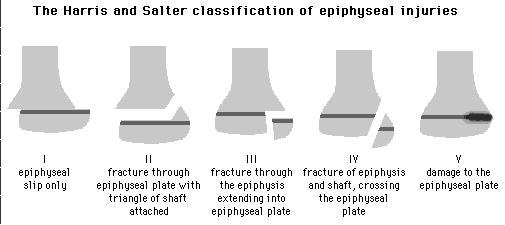 Salter I Epiphysis separate from shaft and Metaphysis through the