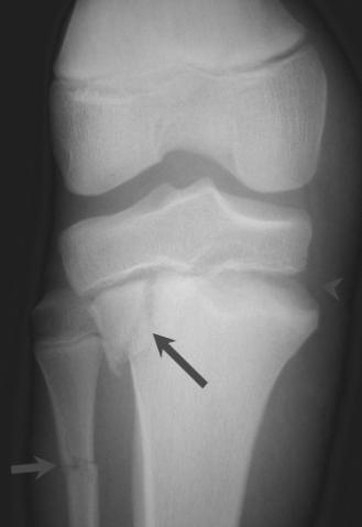 Salter Harris II SH II of proximal tibia (large arrow for fracture of proximal tibial