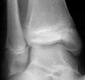 Salter-Harris III fracture of the distal anterolateral tibial epiphysis ( Tillaux fracture).