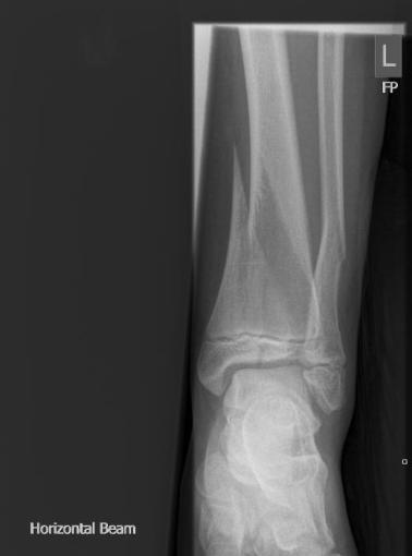 blood supply Needs perfect reduction SH- IV Displaced fracture of the proximal tibia.
