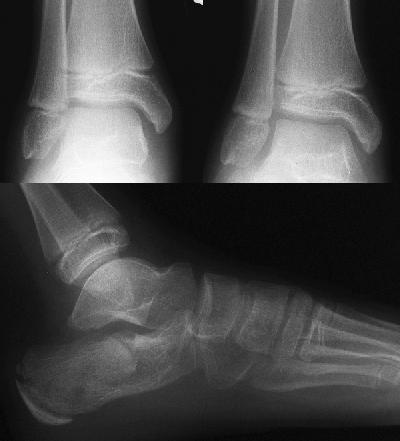 Product of a crushing injury X-ray dx.