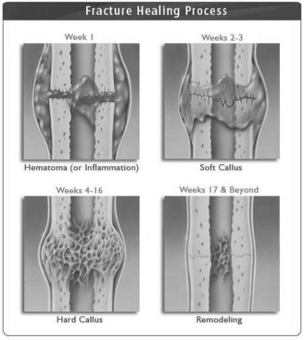 Healing Remodeling occurs by a combination of preinstall reabsorption & new bone formation Anatomic alignment is not always necessary Younger the child the more remodeling Heal with greater