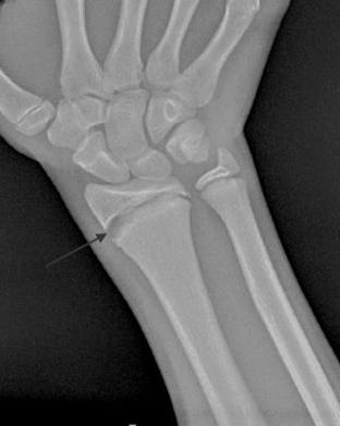 ANATOMIC REDUCTION Gold standard with adults May cause limb leg discrepancy in children (overgrowth) Accept greater angular deformity in children (remodeling) Intra-articular fractures have worse