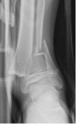 Displaced fractures More prominent swelling More diffuse tenderness Severe pain markedly increased on motion Crepitance on gentle palpation Manipulation must be kept minimal Complications If a