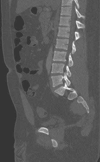 Evaluation of Wedging of Lumbar Vertebral Bodies in Children Fig. 3 Sagittal reformations of spine in three children. A, Standard quality reformation in 14-year-old boy.