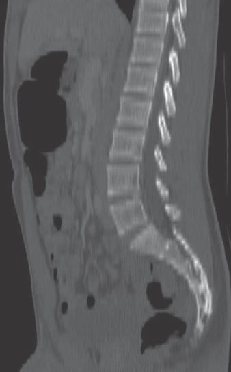 If mild anterior wedging can be seen as a normal variant, misdiagnosis as the sequela of trauma may result in unnecessary imaging of these patients, with unnecessary radiation exposure.