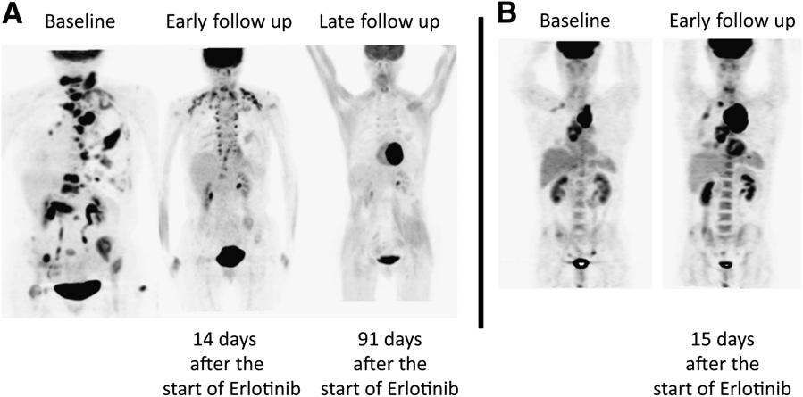 FIGURE 3. F-FDG PET at baseline, early follow-up, and late follow-up in patient classified as PMR and PMD.