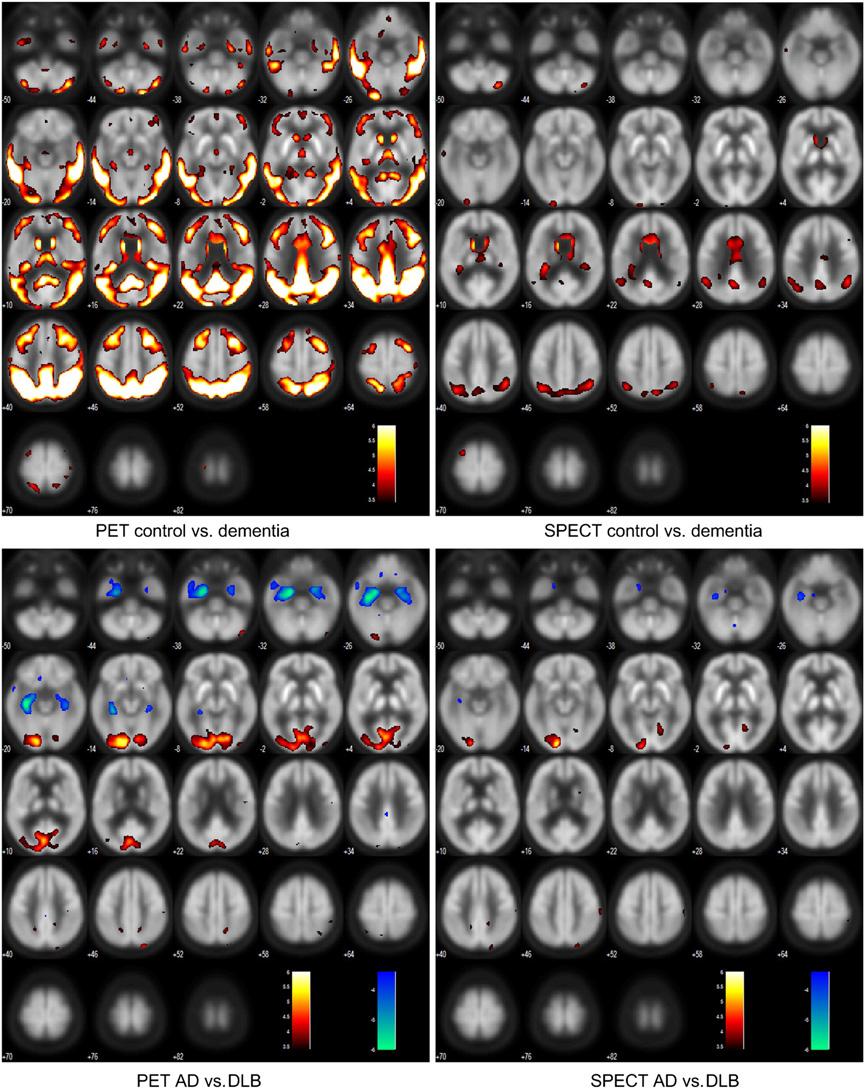 FIGURE 3. SPM results, voxelwise threshold P 5 0.0005, uncorrected for multiple comparisons. Top row shows reduction in all dementia vs. control. Bottom row shows reductions of AD vs.