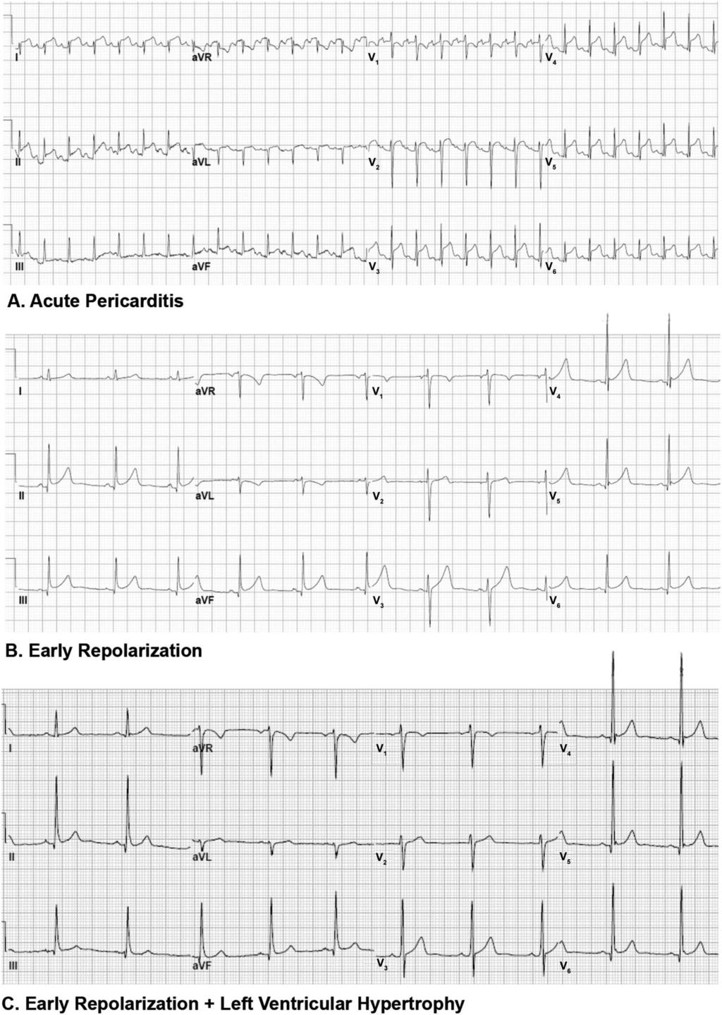 ST/T Ratio in AP, ER and ERLVH FIGURE 1. Electrocardiogram patterns of acute pericarditis (A), early repolarization (B) and early repolarization of left ventricular hypertrophy (C).