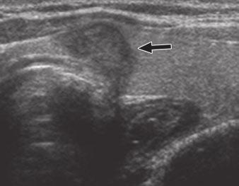 Biopsy of Thyroid Nodules The margin of a nodule was described as well circumscribed or not well circumscribed, which included irregular or microlobulated margins.