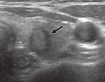 Macrocalcifications or coarse calcifications were defined as larger than 2 mm.