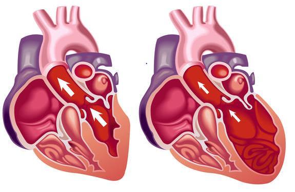 Dilated cardiomyopathy Seen in ~ 1/2,700 people Dilated = open or enlarged Irreversible Symptoms of DCM may include: Edema Orthopnea (trouble breathing when lying down) Difficulty breathing