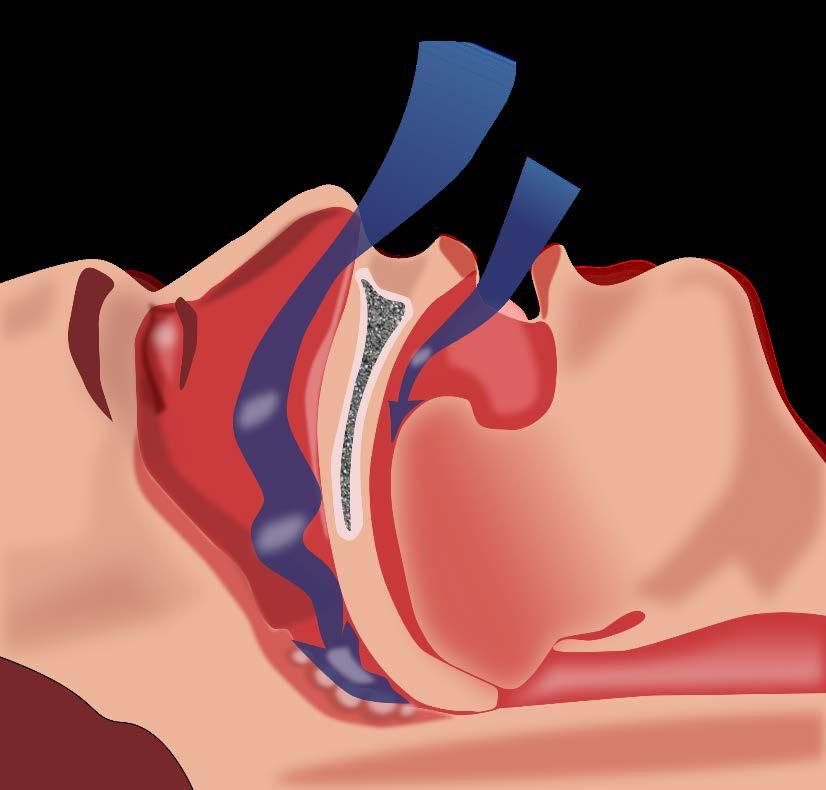 Obstructive sleep apnea (OSA) Syndrome characterized by repetitive episodes of upper airway obstruction during sleep,