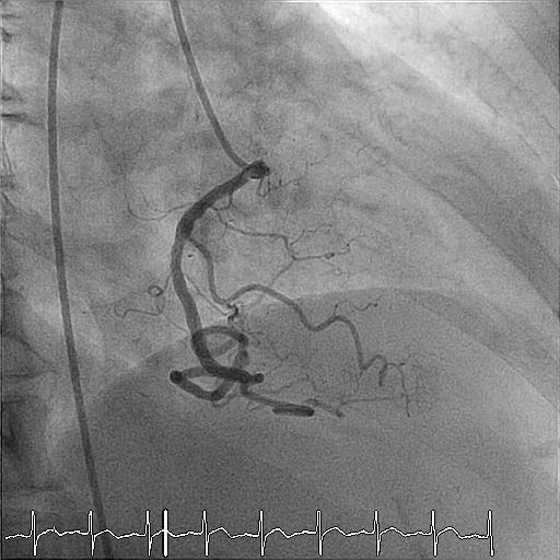 RAO without Cranial RCA RVM?
