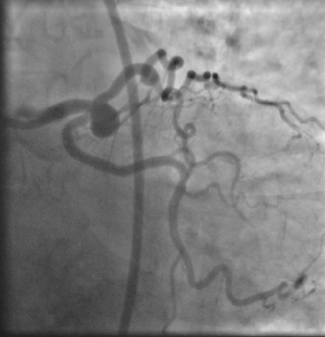 Coronary Artery Aneurysms Coronary Aneurysm: Vessel diameter > 1.5x neighboring segment Incidence: 0.15%-4.