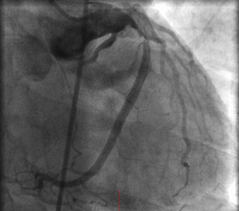 Coronary Angiogram LM T AVM LM=left main LCX