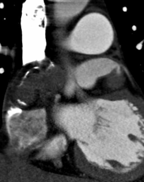CT Angiogram * = entrance of AVM at Left Main (LM)