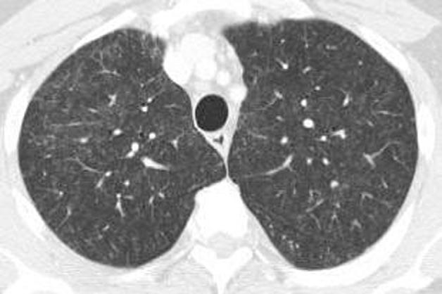 CHEST Postgraduate Education Corner CHEST IMAGING AND PATHOLOGY FOR CLINICIANS Recurrent Fevers, Cough, and Pulmonary Opacities in a Middle-Aged Man Philippe R. Bauer, MD, PhD, FCCP ; Clive S.