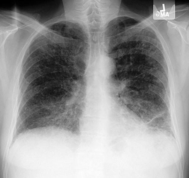 Chest CT scan ( Fig 4 ) showed multilobar opacities, and BAL showed no evidence of malignant cells or infection. He was discharged home on antibiotics but continued to complain of cough and dyspnea.