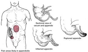 Appendicitis Delay in diagnosis is common (up to 57 % of cases in children less than 6 years of age) Perforation correlates with delayed diagnosis.