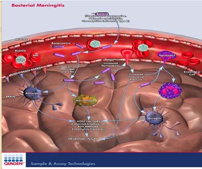 Meningitis Inflammation of the meningeal layers of the CNS May be caused by infection, medications, or malignancy; most commonly caused by infection Infectious