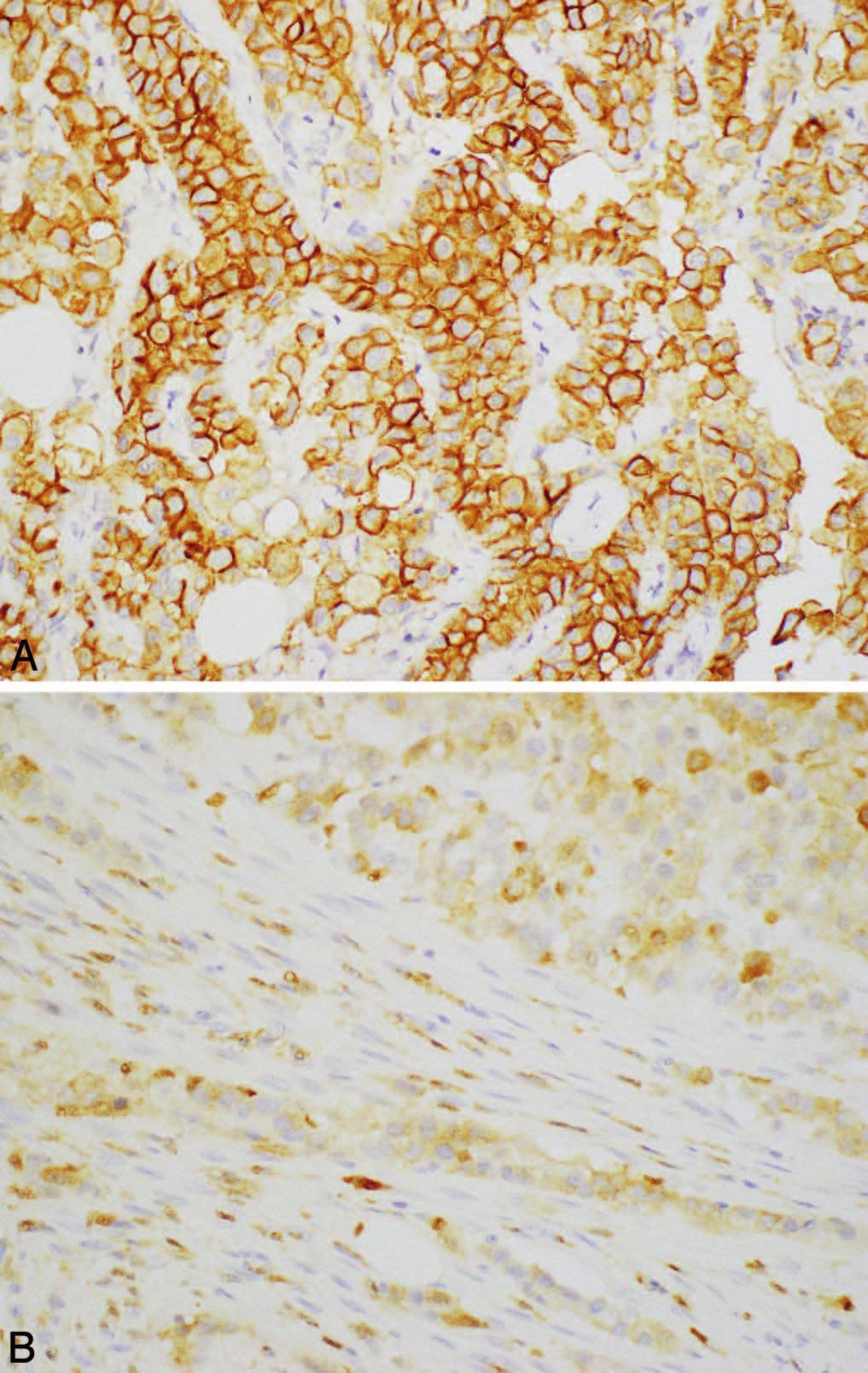 Figure 1. Mesothelin immunohistochemistry in peritoneal mesothelioma. A, Strong membranous immunoreactivity in peritoneal mesothelioma.