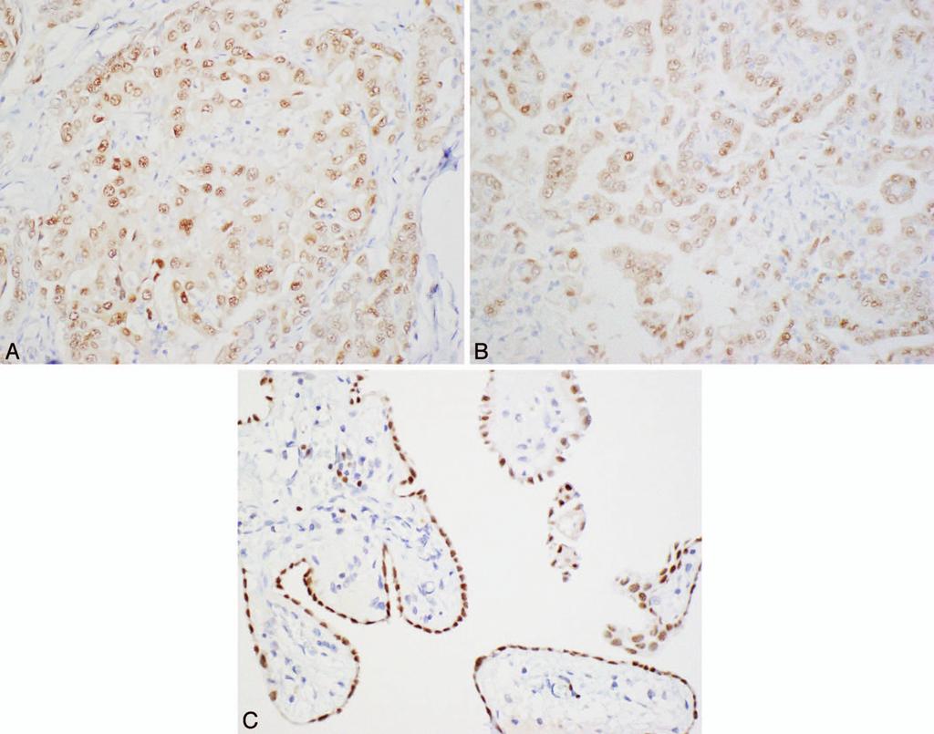 Figure 2. Immunohistochemistry for PAX8 in peritoneal mesothelioma. A, An epithelioid malignant mesothelioma with strong PAX8 staining. B, PAX8 immunoreactivity in a biphasic peritoneal mesothelioma.