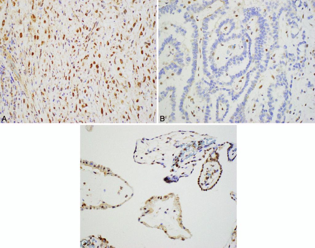 Figure 3. BAP1 in peritoneal mesothelioma. A, Retention of BAP1 immunoreactivity is shown in the spindle cell area of a malignant mesothelioma.