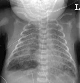 4 Fig. 1 CXR on the first day of life. A pneumothorax on the right side has been drained. During the first 2 weeks, arterial PCO2 values were between 50 and 100 mmhg with a peak of 328 mmhg (43 kpa).
