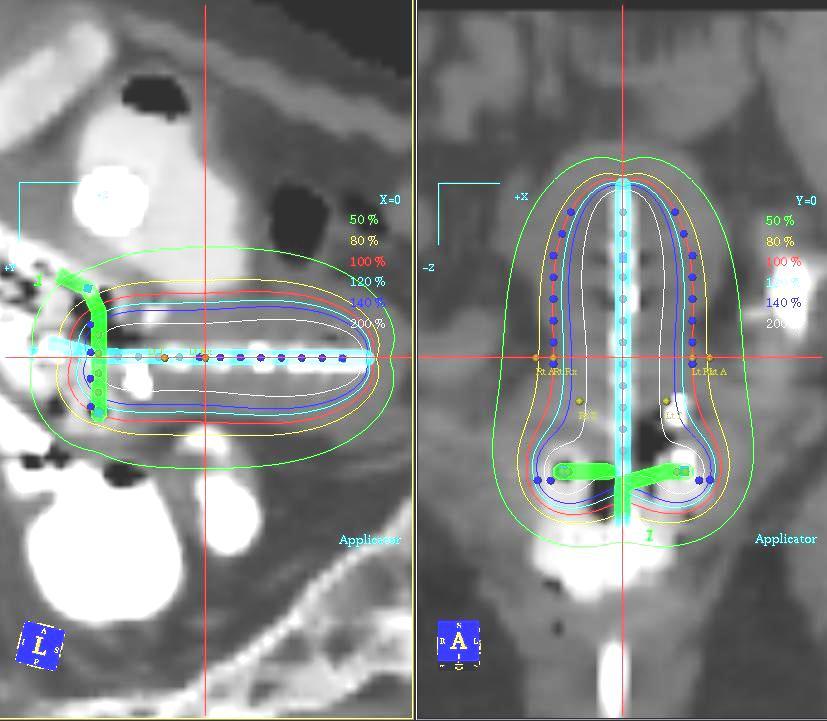 Dosimetry Methods-Tandem and Ring Dose optimization points can also be used to modify the classic location