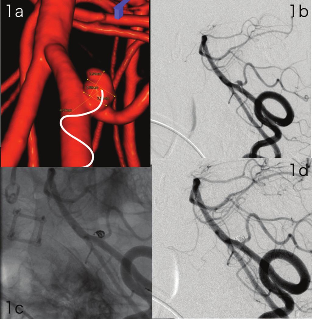 Kuroiwa T, et al. Fig. 1 (a) Volume rendering image of R-VAG shows a PICA aneurysm with a maximum diameter of 2.89 mm.
