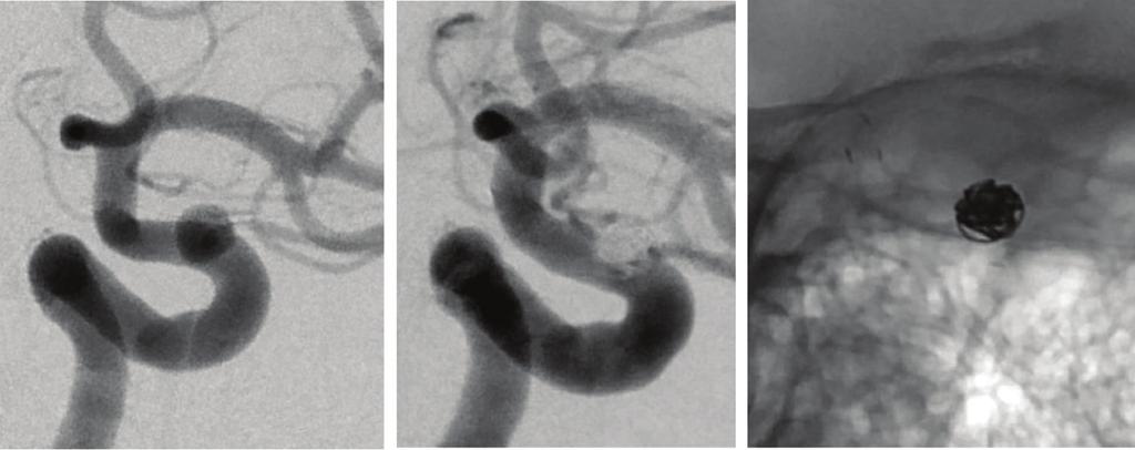 Takayama K, et al. A B C D E F Fig. 1 Coil embolization with the Enterprise stent (ES) for a left ophthalmic artery aneurysm.
